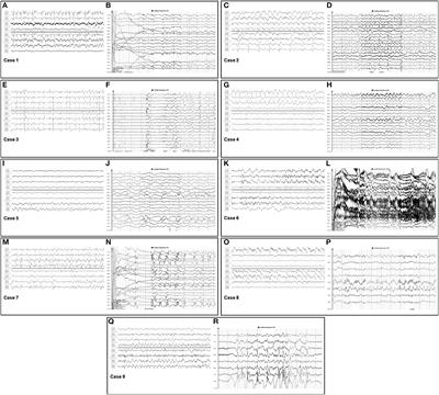 Comparing Seizures Captured by Rapid Response EEG and Conventional EEG Recordings in a Multicenter Clinical Study